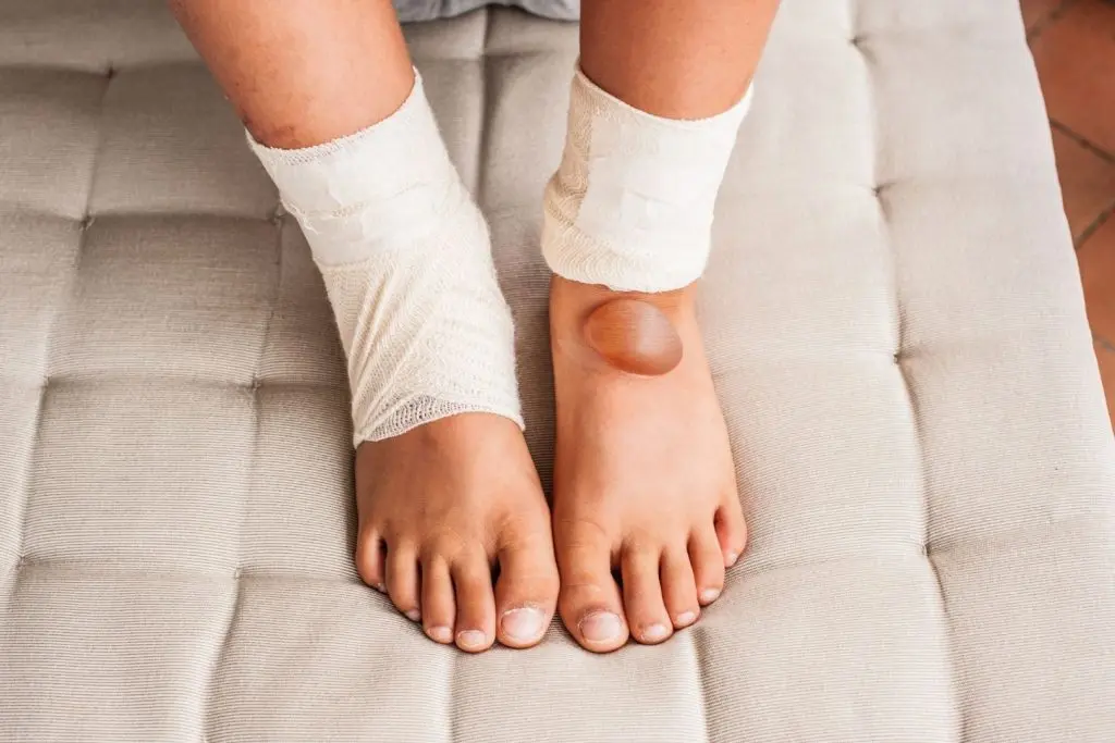 Burn Management and Reconstruction by Dr. Dharmesh JB in Bangalore