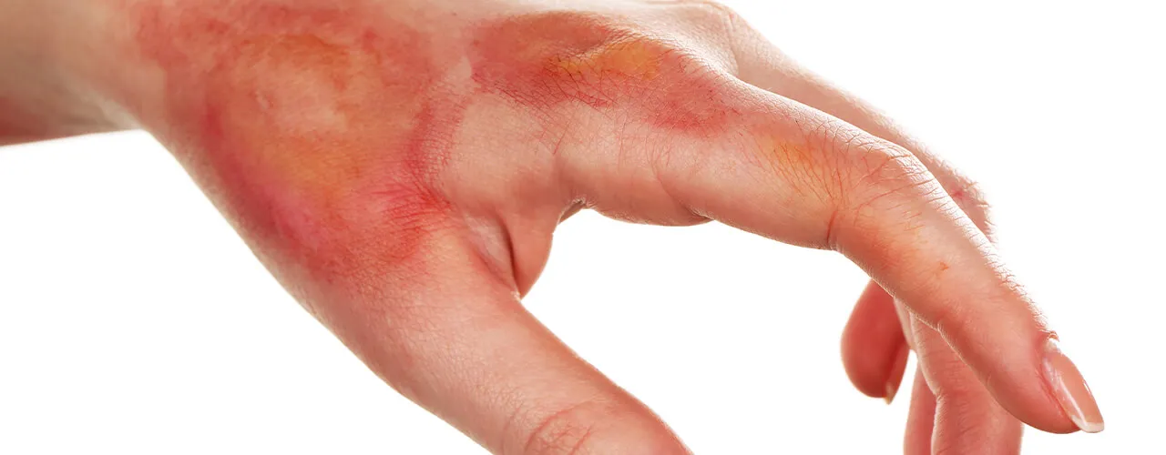 Hand Infection Treatment by Dr. Dharmesh JB in Bangalore