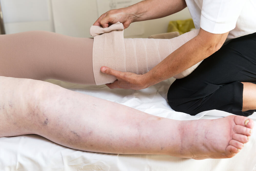 Lymphedema Treatment by Dr. Dharmesh JB in Bangalore