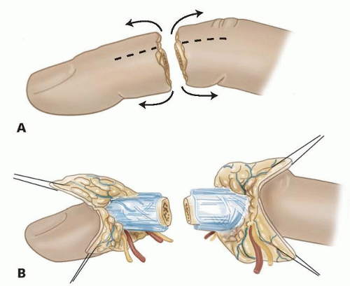 Replantation and Revascularization Surgery by Dr. Dharmesh JB in Bangalore