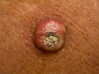 Tumor and Lesion Treatment by Dr. Dharmesh JB in Bangalore