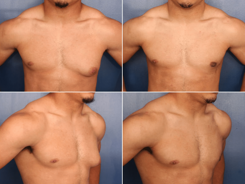 Gynecomastia correction surgery in Bangalore by Dr. Dharmesh JB